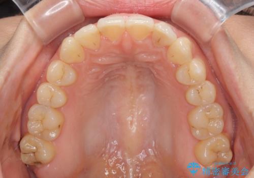 インビザライン矯正で前歯のデコボコを改善の治療中