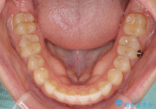 インビザライン矯正で前歯のデコボコを改善の治療中