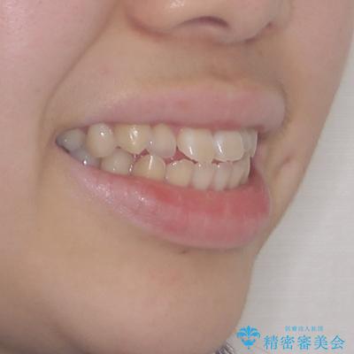 舌突出癖で出っ歯と開咬に 舌のトレーニングを行いながら抜歯矯正 の治療前(顔貌)