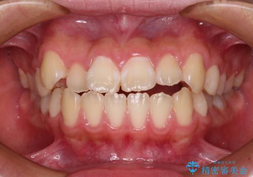 舌突出癖で出っ歯と開咬に　舌のトレーニングを行いながら抜歯矯正　の症例 治療前