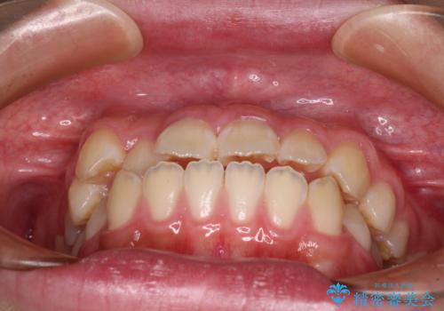 舌突出癖で出っ歯と開咬に 舌のトレーニングを行いながら抜歯矯正 の治療前