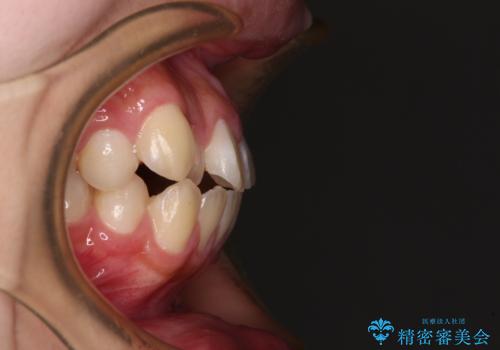 舌突出癖で出っ歯と開咬に 舌のトレーニングを行いながら抜歯矯正 の治療前