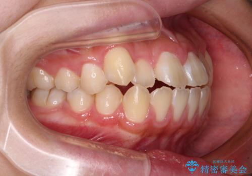 舌突出癖で出っ歯と開咬に 舌のトレーニングを行いながら抜歯矯正 の治療前
