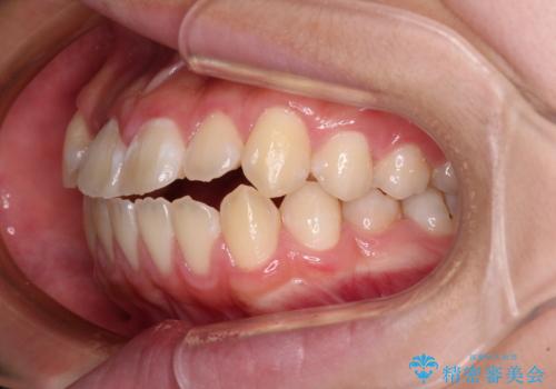 舌突出癖で出っ歯と開咬に 舌のトレーニングを行いながら抜歯矯正 の治療前