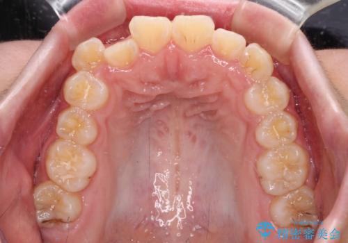 舌突出癖で出っ歯と開咬に　舌のトレーニングを行いながら抜歯矯正　の治療前