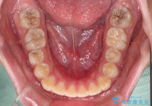 舌突出癖で出っ歯と開咬に 舌のトレーニングを行いながら抜歯矯正 の治療前