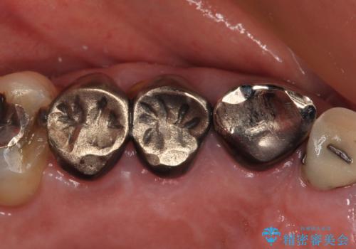 破折した歯 オールセラミックブリッジの補綴治療の治療前