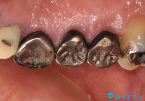 破折した歯 オールセラミックブリッジの補綴治療の治療前