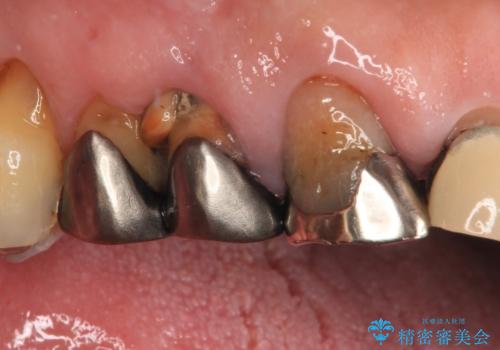 破折した歯 オールセラミックブリッジの補綴治療の症例 治療前