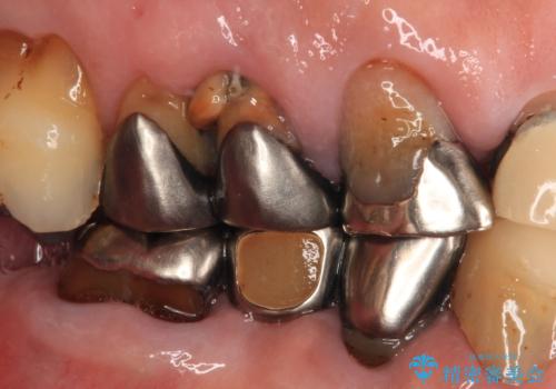 破折した歯 オールセラミックブリッジの補綴治療の治療前