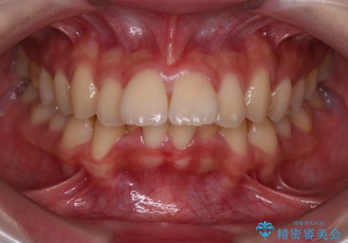 【インビザライン】アンカースクリューを用いた遠心移動の治療前