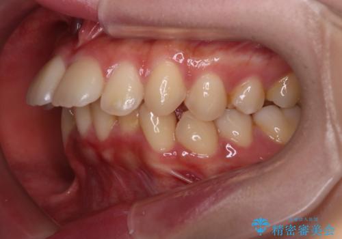 【インビザライン】アンカースクリューを用いた遠心移動の治療前