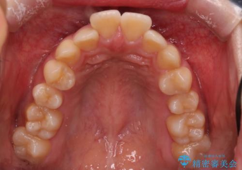 【インビザライン】アンカースクリューを用いた遠心移動の治療前