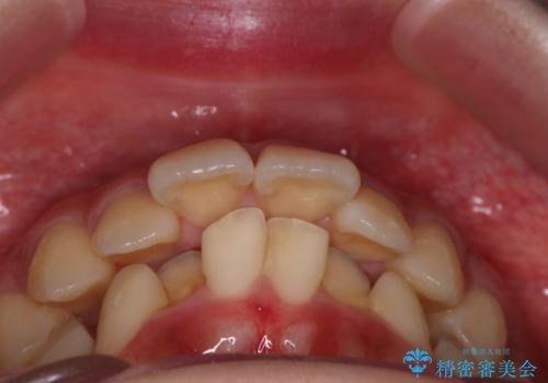 【インビザライン】アンカースクリューを用いた遠心移動の治療前