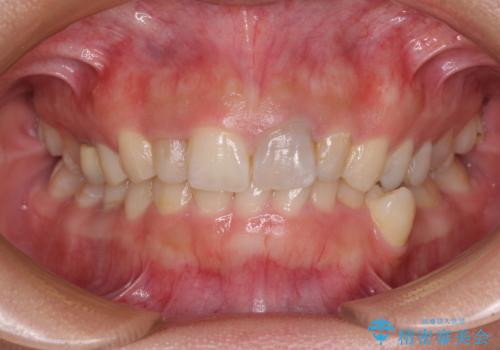 歯列から飛び出た歯　ワイヤー矯正で整った歯列にの症例 治療前