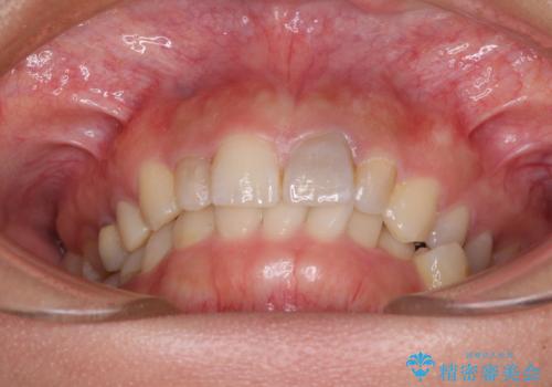 歯列から飛び出た歯 ワイヤー矯正で整った歯列にの治療前