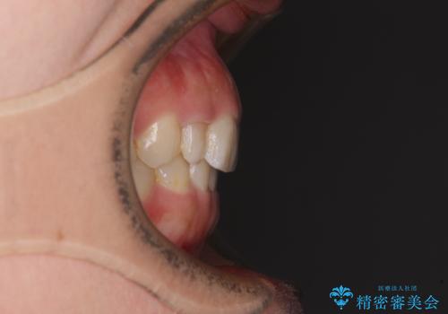 歯列から飛び出た歯 ワイヤー矯正で整った歯列にの治療前