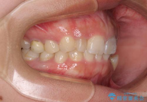 歯列から飛び出た歯 ワイヤー矯正で整った歯列にの治療前