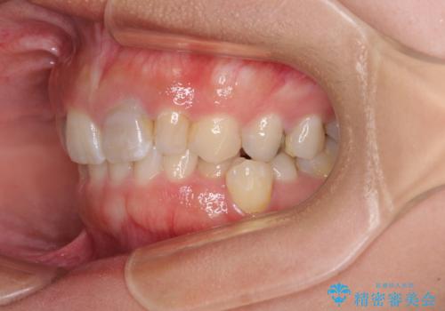 歯列から飛び出た歯　ワイヤー矯正で整った歯列にの治療前