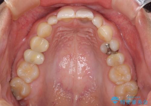 歯列から飛び出た歯 ワイヤー矯正で整った歯列にの治療前