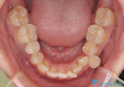 歯列から飛び出た歯 ワイヤー矯正で整った歯列にの治療前