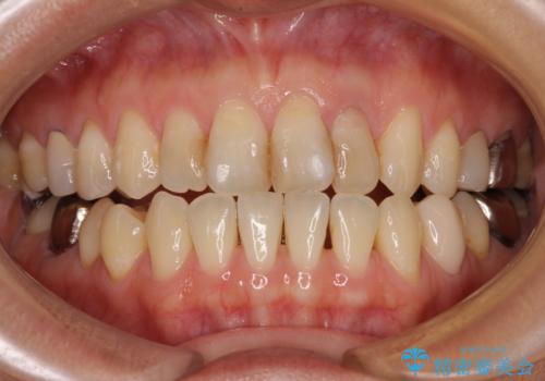 根元がうずく前歯 根管治療とオールセラミック治療の治療前