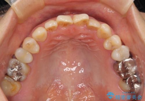 根元がうずく前歯 根管治療とオールセラミック治療の治療前