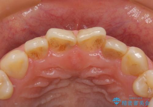 根元がうずく前歯 根管治療とオールセラミック治療の治療前