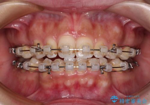 唇が閉じにくい ワイヤー装置での抜歯矯正の治療中