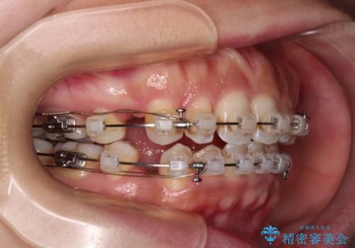 唇が閉じにくい　ワイヤー装置での抜歯矯正の治療中