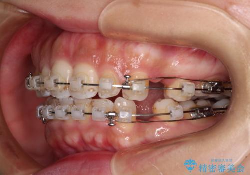 唇が閉じにくい ワイヤー装置での抜歯矯正の治療中