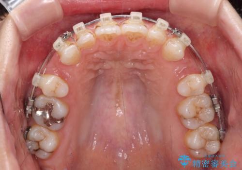 唇が閉じにくい ワイヤー装置での抜歯矯正の治療中