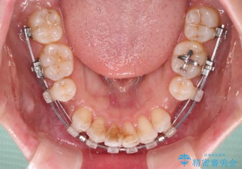 唇が閉じにくい　ワイヤー装置での抜歯矯正の治療中