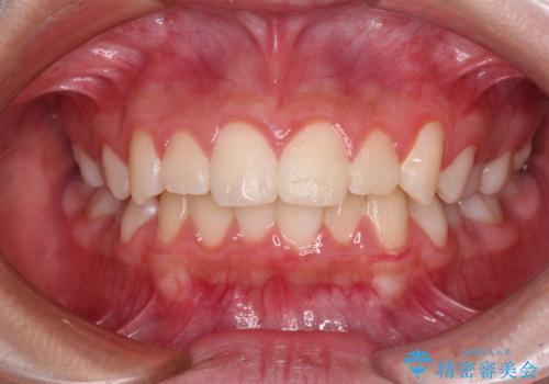 気がつくと唇があいてしまう ワイヤー装置での抜歯矯正の症例 治療前