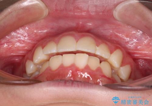 気がつくと唇があいてしまう ワイヤー装置での抜歯矯正の治療前