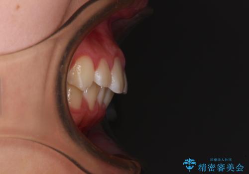 気がつくと唇があいてしまう ワイヤー装置での抜歯矯正の治療前