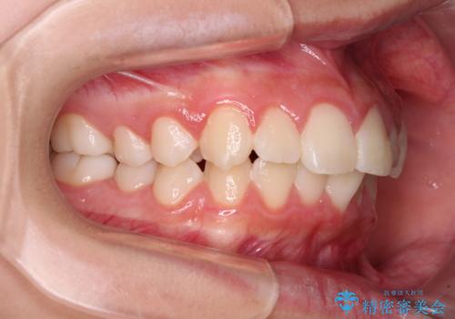 気がつくと唇があいてしまう ワイヤー装置での抜歯矯正の治療前
