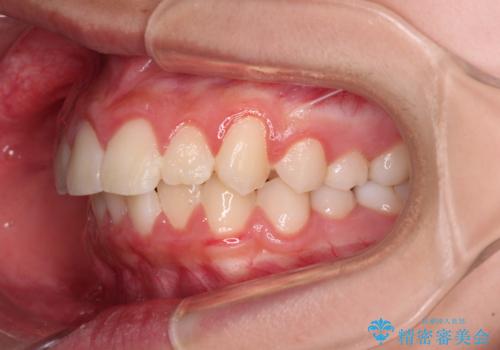 気がつくと唇があいてしまう ワイヤー装置での抜歯矯正の治療前