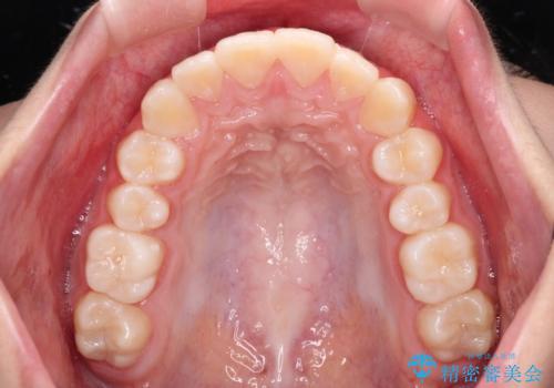 気がつくと唇があいてしまう ワイヤー装置での抜歯矯正の治療前