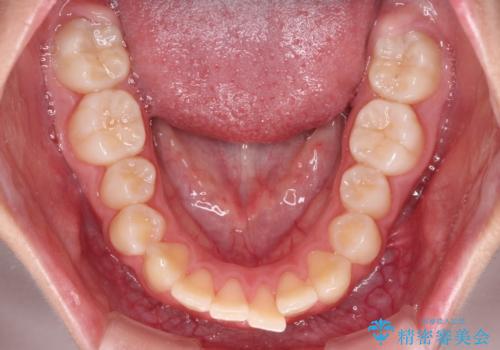 気がつくと唇があいてしまう ワイヤー装置での抜歯矯正の治療前
