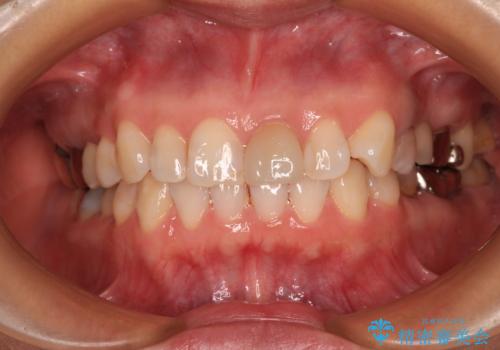 気になる下顎歯列のみをインビザラインで部分矯正の治療中