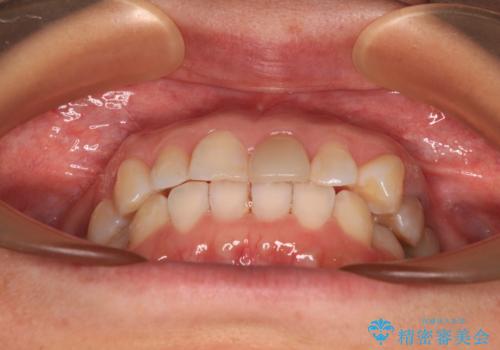 気になる下顎歯列のみをインビザラインで部分矯正の治療中