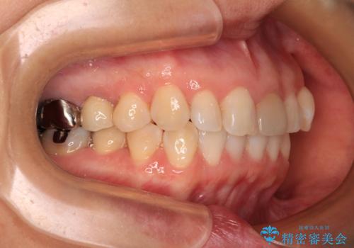 気になる下顎歯列のみをインビザラインで部分矯正の治療中