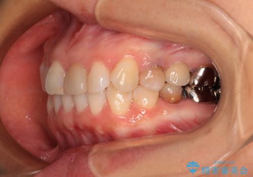 気になる下顎歯列のみをインビザラインで部分矯正の治療中