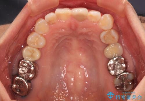 気になる下顎歯列のみをインビザラインで部分矯正の治療中