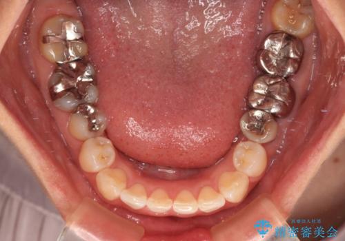 気になる下顎歯列のみをインビザラインで部分矯正の治療中