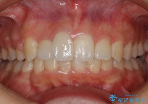 前歯の不自然なセラミック　下のすきっ歯　矯正治療で総合的に美しくの症例 治療後