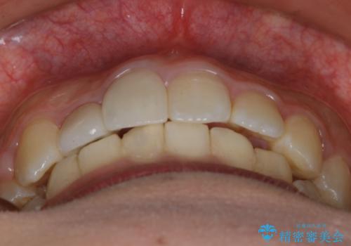 前歯の不自然なセラミック　下のすきっ歯　矯正治療で総合的に美しくの治療後