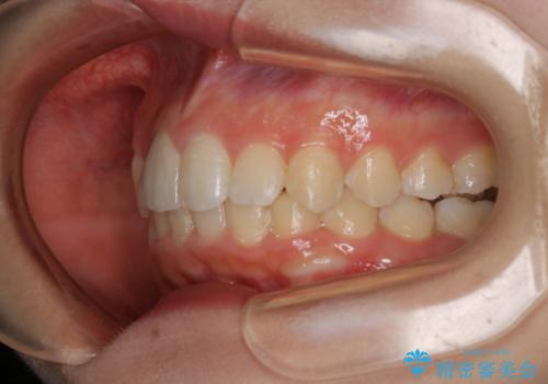 前歯の不自然なセラミック 下のすきっ歯 矯正治療で総合的に美しくの治療後