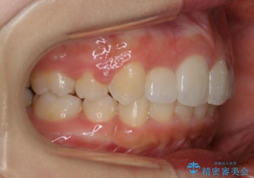 前歯の不自然なセラミック 下のすきっ歯 矯正治療で総合的に美しくの治療後